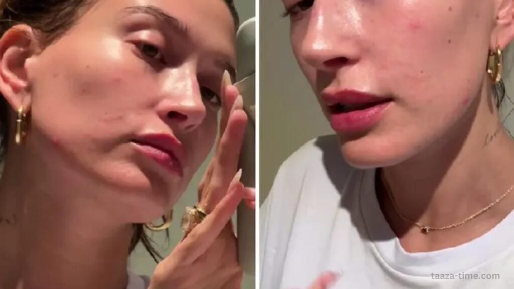Hailey Bieber Opens Up About Her Skin Disorder Flare-ups