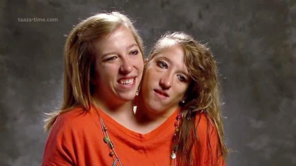 Conjoined Twin Abby Hensel got married