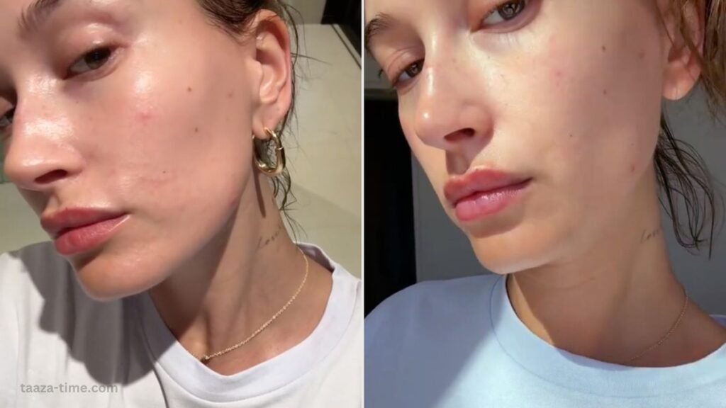 Hailey Bieber Opens Up About Her Skin Disorder Flare-ups
